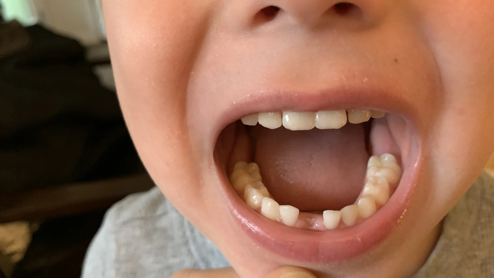 Close-up of a child's smile with a missing bottom front tooth.